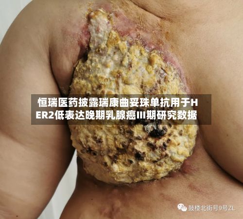 恒瑞医药披露瑞康曲妥珠单抗用于HER2低表达晚期乳腺癌Ⅲ期研究数据-第2张图片